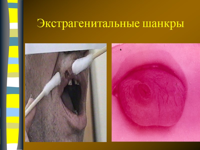 09.12.2017 Экстрагенитальные шанкры